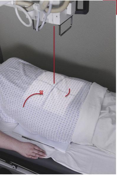 <ul><li><p>Top of IR should be 1” above iliac crests</p></li><li><p>Ensure no rotation — both ASIS should be same distance from IR</p></li><li><p>Rotate lower limbs internally 15 degrees if possible</p></li></ul><p></p>