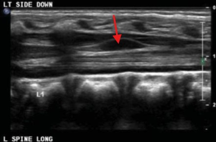 <p>This cyst like structure was found in the filum terminale. What can be assumed here?</p>