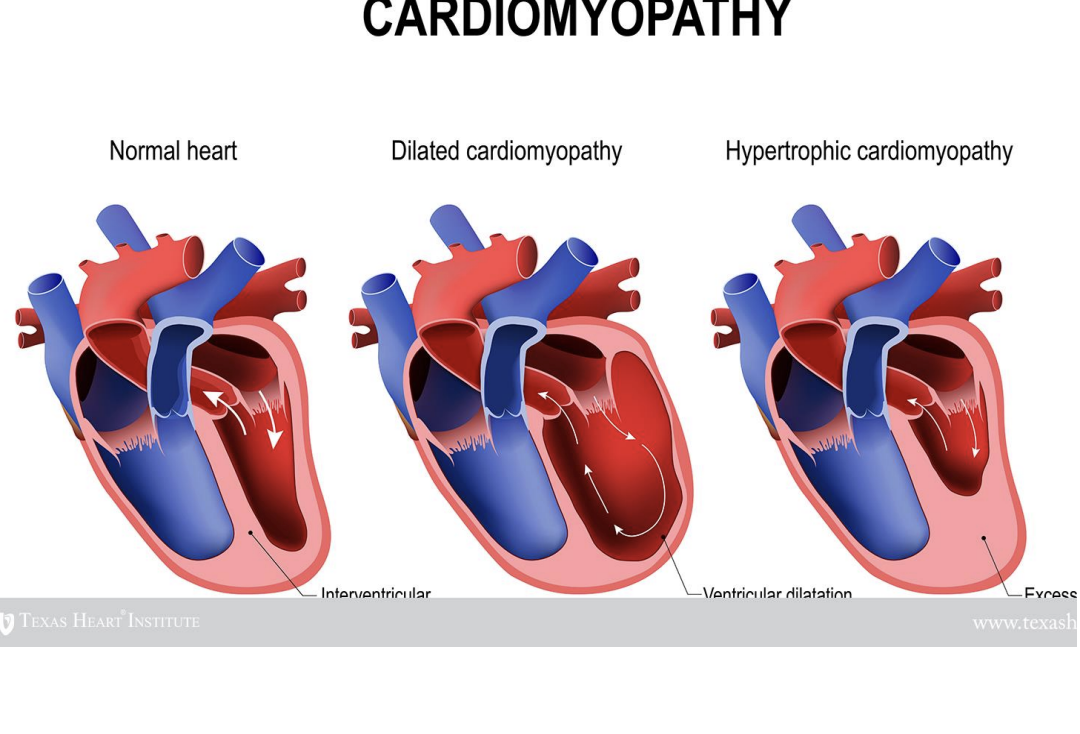 <ol><li><p><span style="background-color: transparent;"><span>Dialated cardiomyopath</span></span></p><ol><li><p><span style="background-color: transparent;"><span>Results in valvar dilation</span></span></p></li></ol></li><li><p><span style="background-color: transparent;"><span>Hypertrophic cardiomyophphy</span></span></p><ol><li><p><span style="background-color: transparent;"><span>Reductuction in in chamber space in the left ventricle</span></span></p></li></ol></li></ol><p></p>