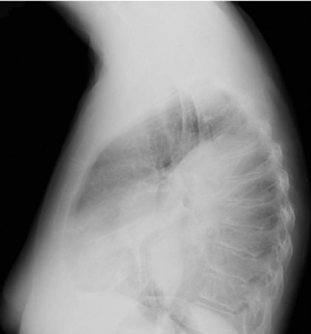 <p>Pus in the pleural space. Appears elliptical and can be loculated. Best visualized w/ CT scan</p>