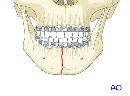 <p>midline area of the mandible</p>