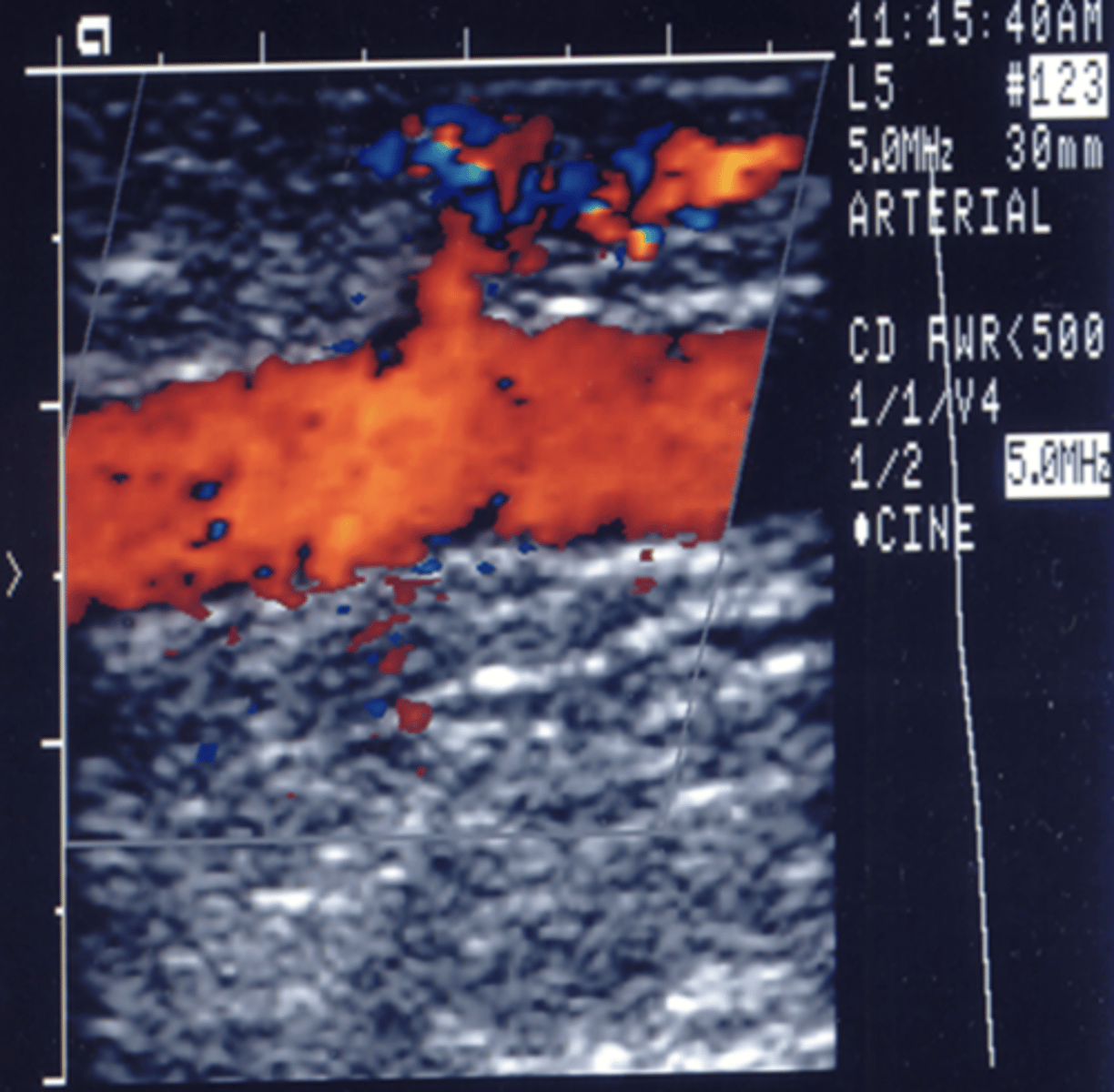<p>Patent venous tributary that may communicate with deep venous system</p><p>Color flow is turbulent with aliasing</p><p>Spectral may be pulsatile or continuous</p><p>Proximal antegrade diastolic flow evident in graft</p>