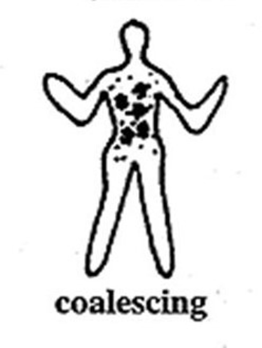 <p>lesions that have grown together</p>