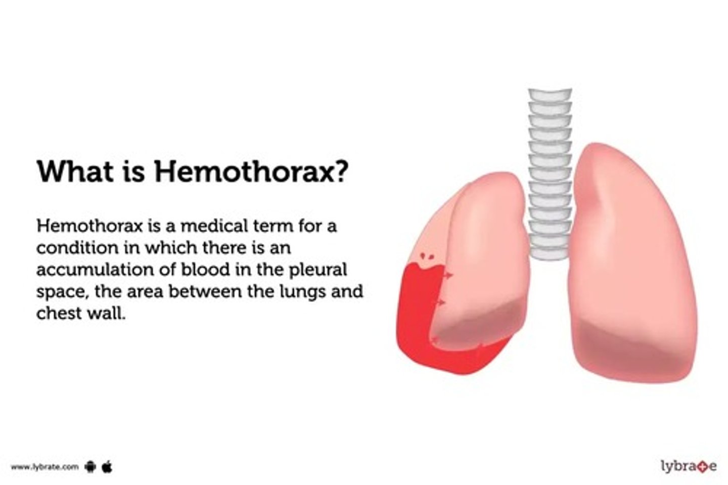 <p>- blood in the pleural space caused by bleeding (hemorrhaging)</p><p>- risk of hypovolemia &amp; hypovolemic shock</p><p>- risk of low CO &amp; cardiogenic shock</p>