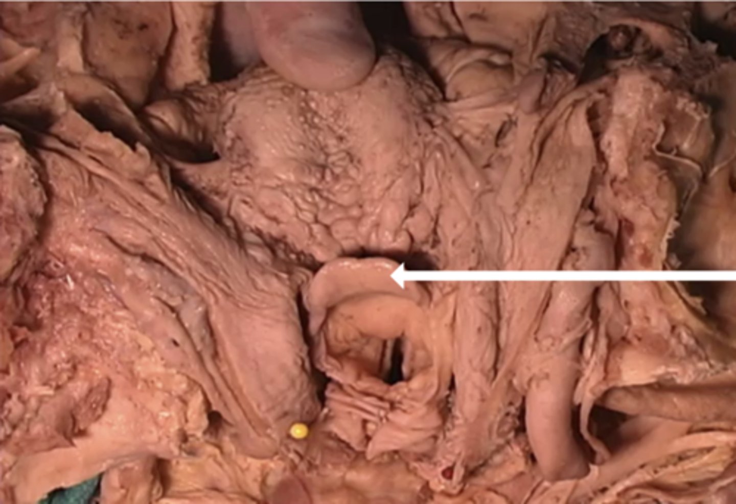 <p>-epiglottis</p><p>-hyoid bone</p><p>-pharynx</p><p>-esophagus</p>