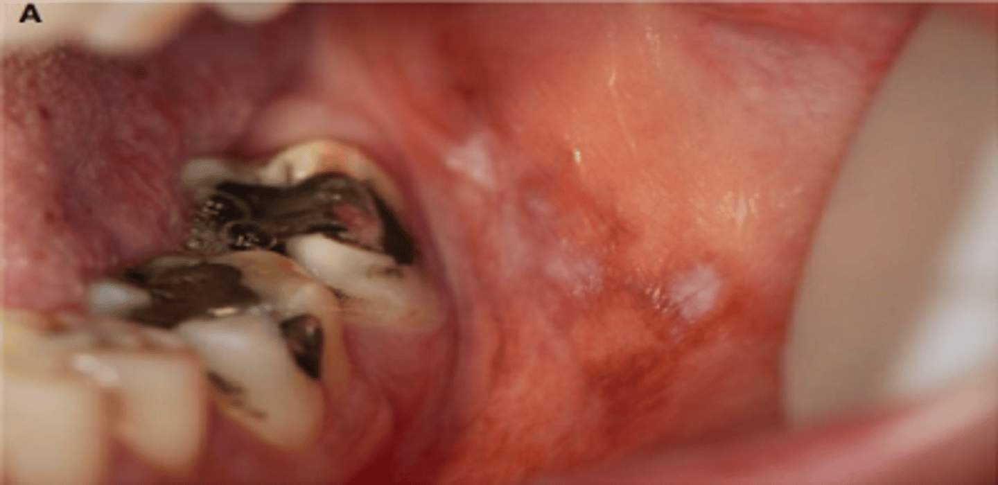 <p>similar to lichen planus - unilateral</p><p>• usually a drug rxn</p><p>• common locations: buccal mucosa, tongue (NOT GINGIVA!!!)</p>