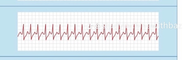 <p>SUPER fast = SUPRAventricular </p>