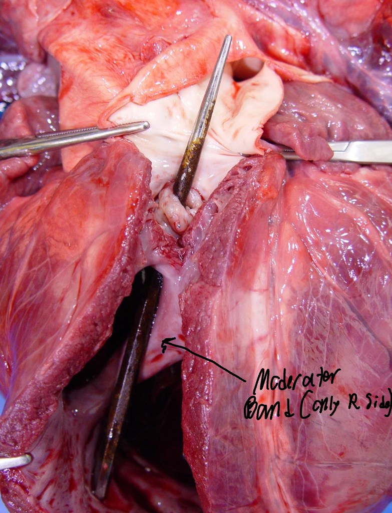 <ul><li><p>Narrowing of the Pulmonary a. (carries blood from RV→Lungs for oxygenation)</p></li></ul><p></p><ol><li><p>The types are classified based off of the location of stenosis in regard to the valve</p><ol><li><p>Valvular</p></li><li><p>Subvalvular</p></li><li><p>Supravalvular</p></li></ol></li></ol><p></p>