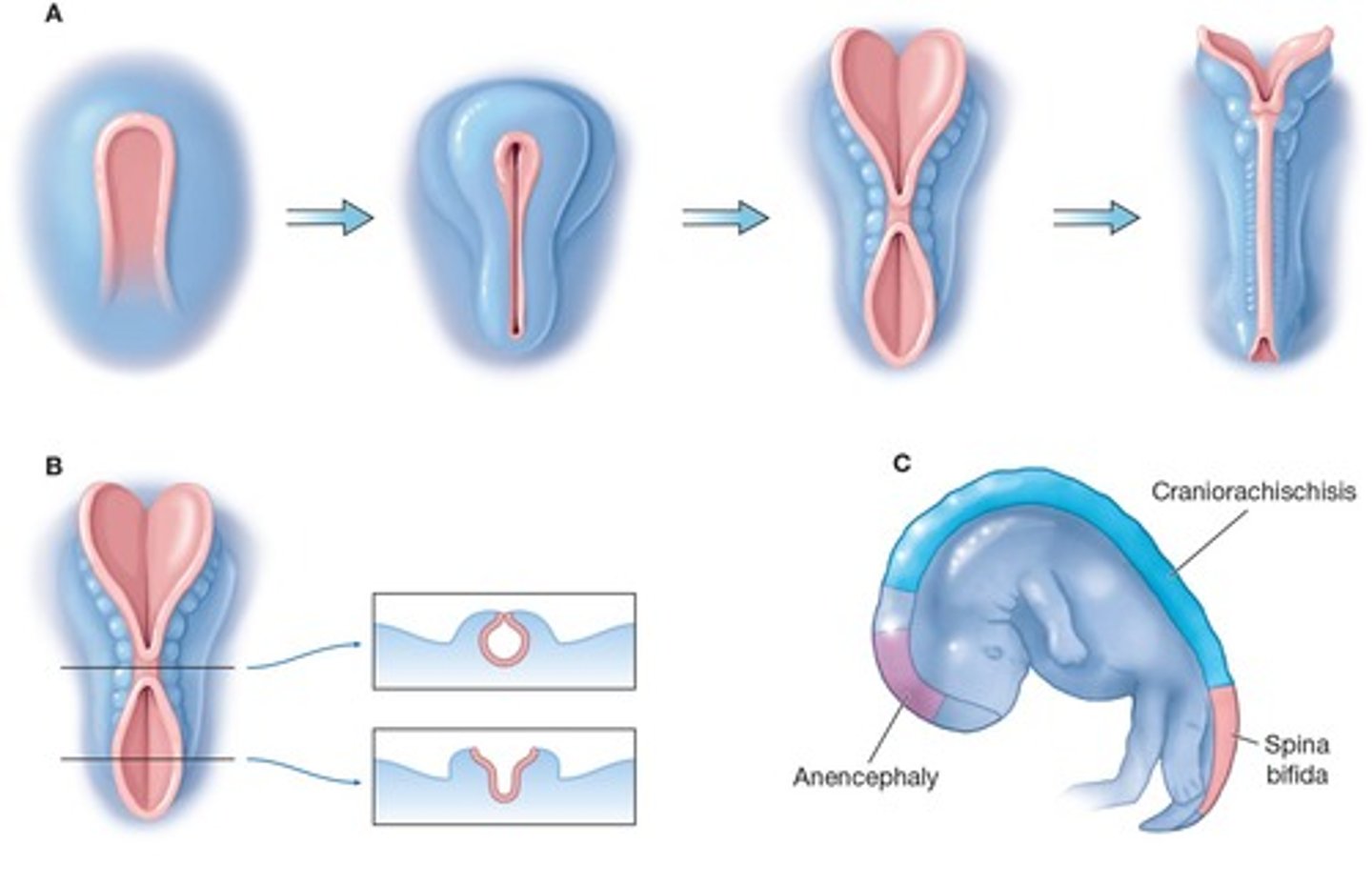 <p>Anencephaly, where the embryo does not develop a brain above the brain stem.</p>