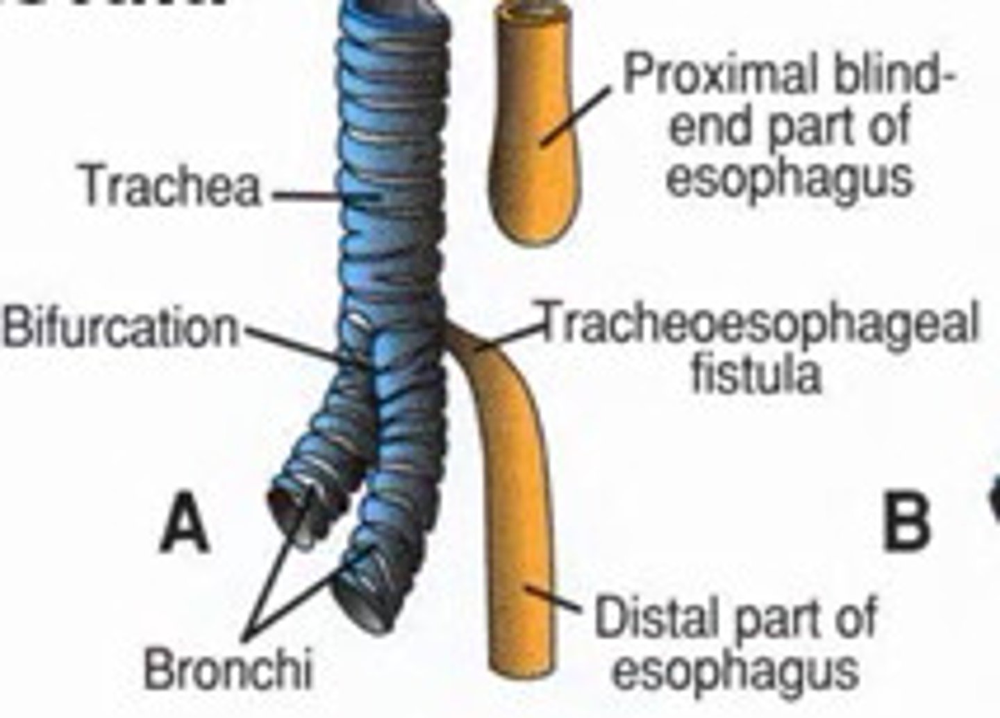 <p>The trachea and the esophagus start forming as 1 tube. At 4 to 8 weeks of pregnancy, a wall forms between the esophagus and trachea. This separates them into 2 tubes. TE fistula and esophageal atresia happen when this wall doesn't form as it should. Usually sporadic but also associated with aneuploidy and VACTERL</p>