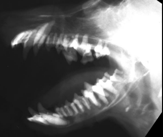 <p>Hyperparathyroidism</p>