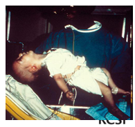 <p>botulism: associates with contaminated food products, usually pork and canned foods with spores or from wound</p><p>Botox (toxin) results in flaccid paralysis</p><p>serious illness requiring intensive care, toxin neutralization, antibiotics and wound debridement </p>
