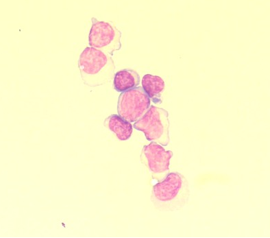 <p>Which cells should be identified in the CSF report for the cytospin field shown?</p><p>Monocytes</p><p>Blast cells</p><p>Lymphocytes</p><p>Plasma cells</p>
