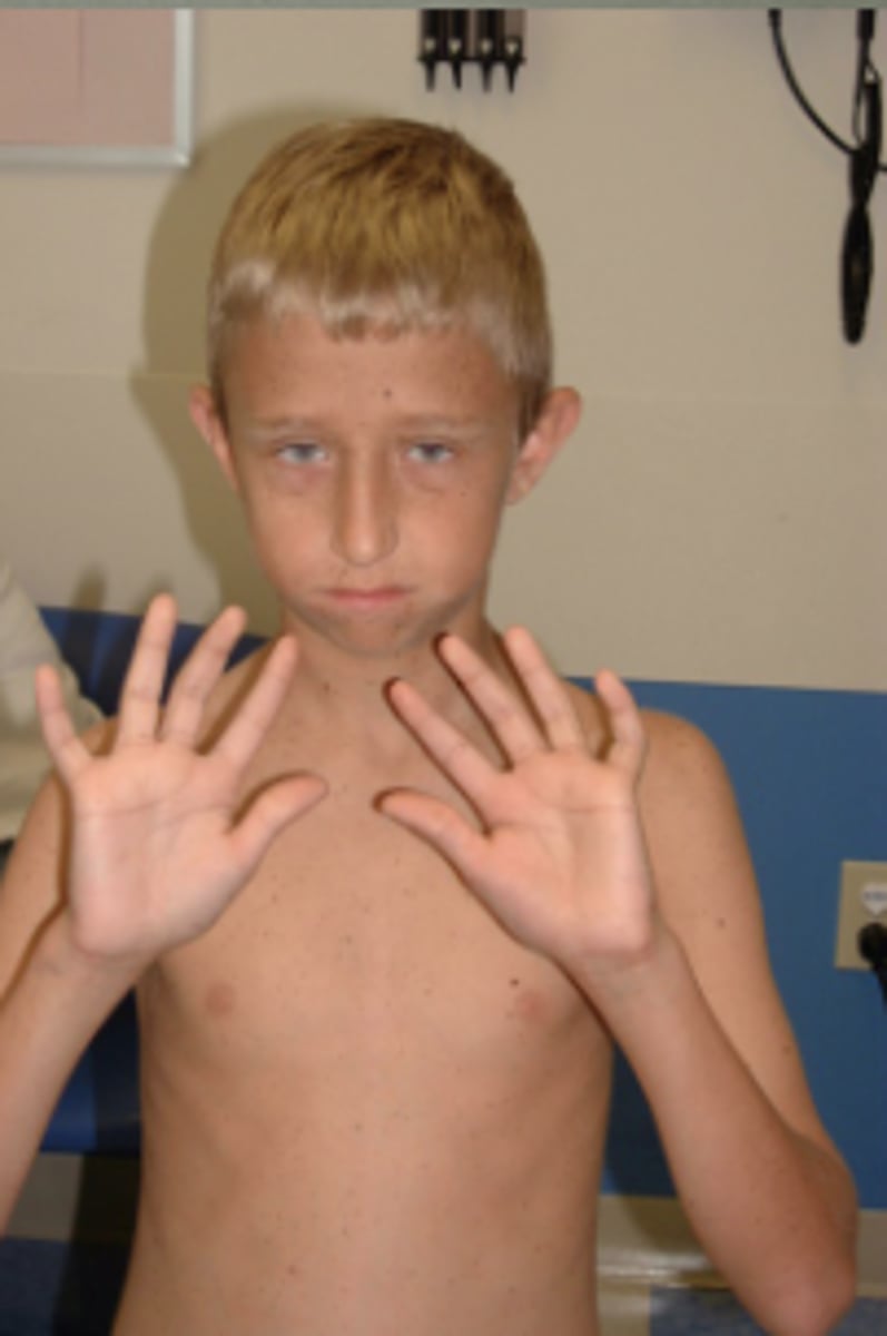 <p>LEOPARD syndrome</p><p>(lentigines)</p>