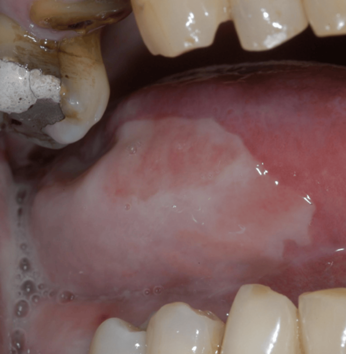 <p>Pain</p><p>Ulceration</p><p>Odynophagia</p><p>Secondary infections</p><p>reduced oral intake</p>