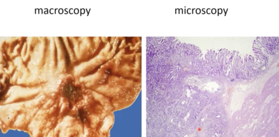“Intestinal type” just because the precursor is intestinal metaplasia → but it is not in the bowel its in the stomach 