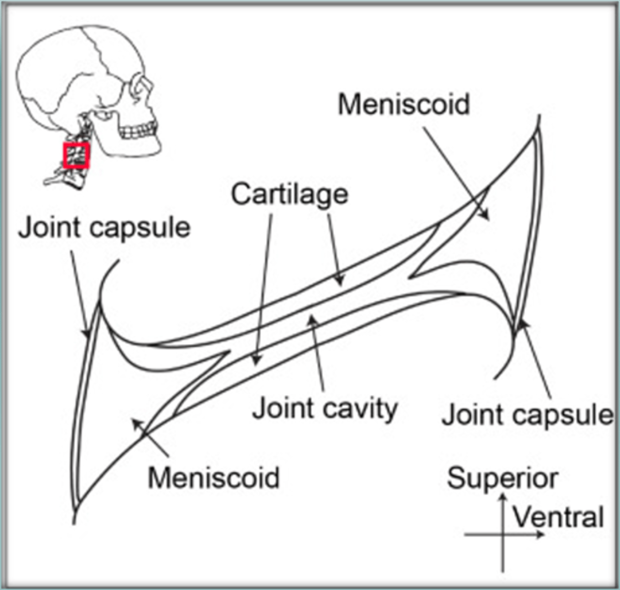<p>could be caused by meniscoid entrapment</p><p>- often happens after prolonged positioning of the neck (ex. falling asleep in weird position)</p><p>- can also happen at UV joints</p>
