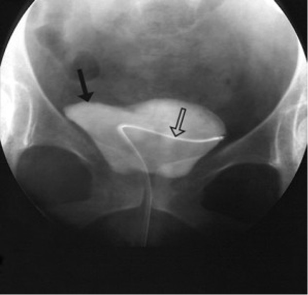 <p>Catheter placed directly into bladder, urine is drained and water soluble contrast is injected</p><p>urethral evaluation is done during voiding the contrast material</p>