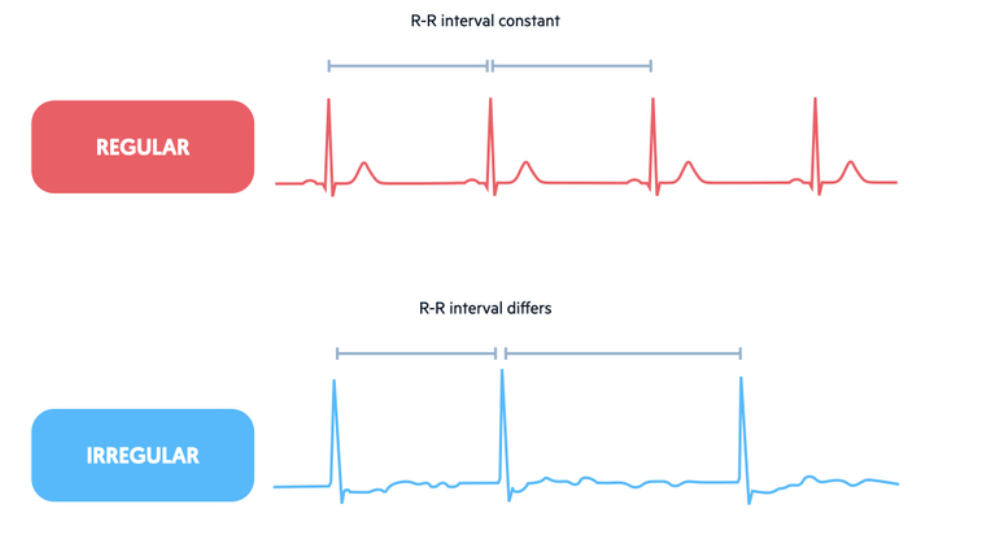 <p>Check spacing between <strong>R-R intervals</strong> across the strip → if consistent, the rhythm is <strong>regular</strong></p><p></p>