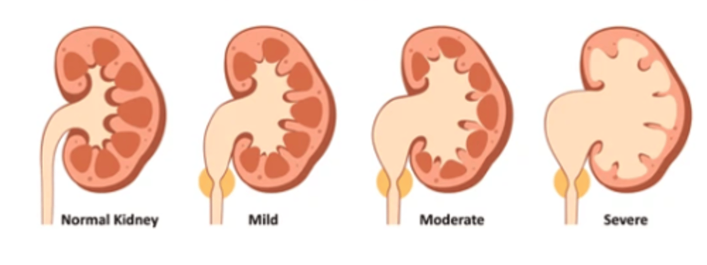 <p>the swelling of the kidney due to build-up of urine</p><p>urine cannot drain from kidney to bladder due to blockage or obstructions (often a urinary calculi/kidney stone), sometimes anatomical or scarring</p>