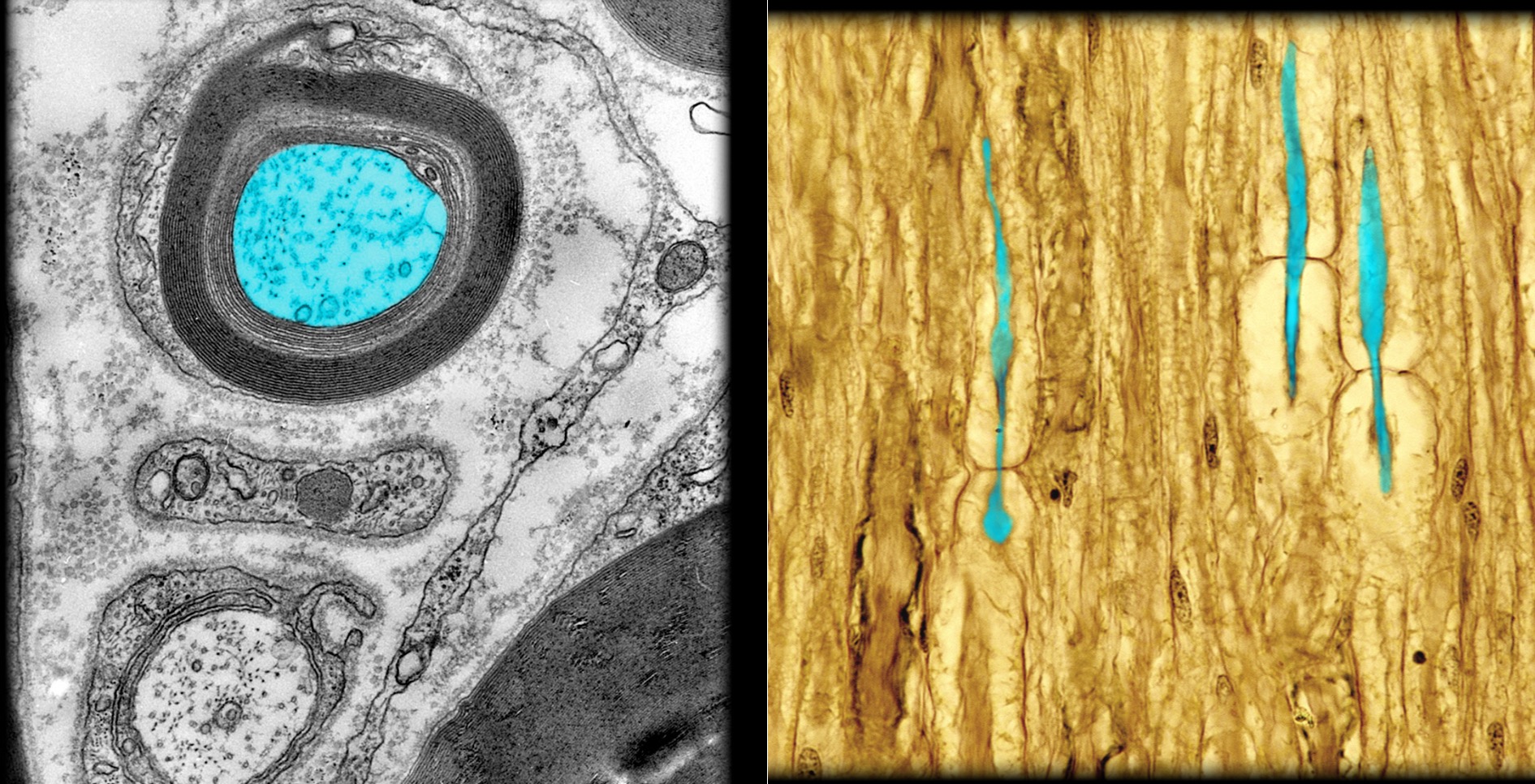 <h4 collapsed="false" seolevelmigrated="true"><strong>Location:</strong></h4><ul><li><p>Central nervous system (CNS)</p></li><li><p>Peripheral nervous system (PNS)</p></li></ul><h4 collapsed="false" seolevelmigrated="true"><strong>Description:</strong></h4><ul><li><p>Axon (usually 2 µm) wrapped by myelin sheath (layered spirals of myelin)</p></li></ul><h4 collapsed="false" seolevelmigrated="true"><strong>Function:</strong></h4><ul><li><p>Conveys efferent nerve impulses (i.e., away from soma)</p></li><li><p>Conveys information to other neurons or effectors</p></li><li><p>Myelin sheath increases speed of nerve impulse conduction</p></li></ul><h4 collapsed="false" seolevelmigrated="true"><strong>Comment:</strong></h4><ul><li><p>Nerve impulses travel faster (3-15 m/sec) in small myelinated axons than in unmyelinated axons of similar size (0.5-2.0 m/sec)</p></li><li><p>Myelinating cell is oligodendrocyte (CNS) or Schwann cell (PNS)</p></li><li><p>Aggregates of myelinated axons in CNS known as white matter</p></li></ul>