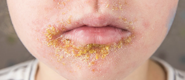 <ul><li><p>Highly contagious bacterial skin infection, usually <em>Staphylococcus aureus</em> or GABHS.</p></li><li><p><strong>Manifestations:</strong> Characteristic <strong>honey-colored crusts</strong> often around the nose and mouth.</p></li><li><p>contact</p></li></ul><p></p>