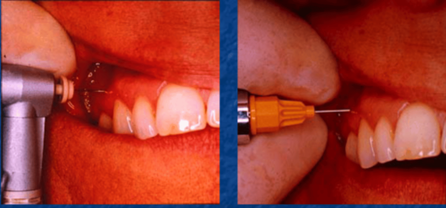 <p>deposition of solution into the interproximal bone between two teeth</p>