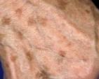 <p><span>A well-defined area with a change in skin color. It is totally flat. If one runs their finger over the area it cannot be felt.</span></p>