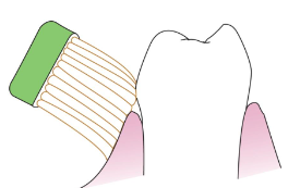 <p><span><strong>• Bristles positioned apically along the long axis of the tooth</strong></span></p><p><span><strong>• Edge of the brush head touches the facial or lingual aspect of the tooth</strong></span></p><p><span><strong>• Brush is slightly rotated at a 45-degree angle and vibrated over the crown</strong></span></p><p><span><strong>• Massage and stimulate gingiva while cleansing cervical areas</strong></span></p>