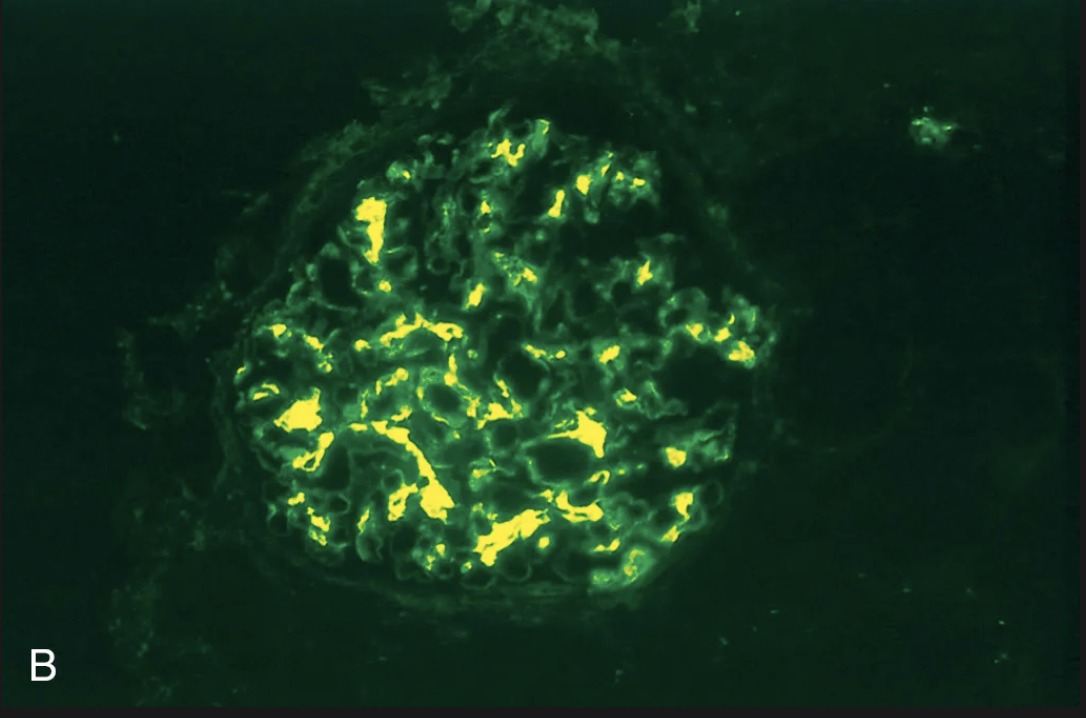 <p>IgA; C3; properdina</p>