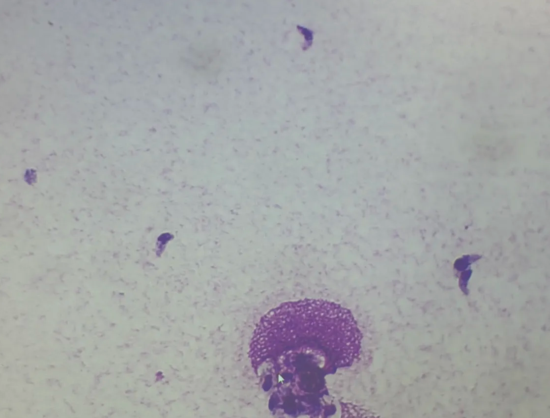 <p>abdominal fluid</p>