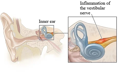 <p>vertigo w/o hearing loss, spontaneous horizontal nystagmus; acute vestibular nerve inflammation w/o cochlear involvement</p>