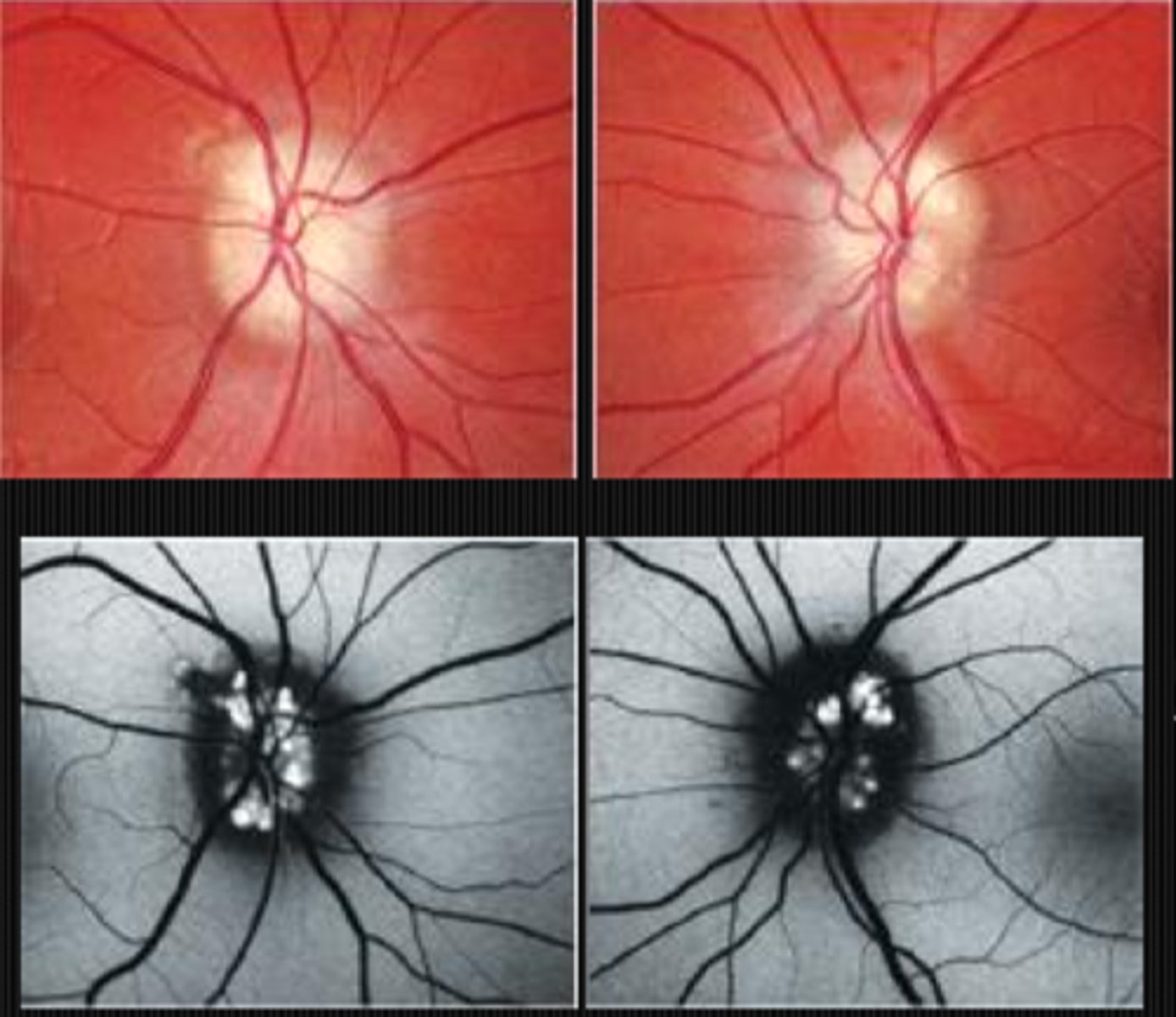 <p>hyperAF drusen within the hypoAF nerve head</p>