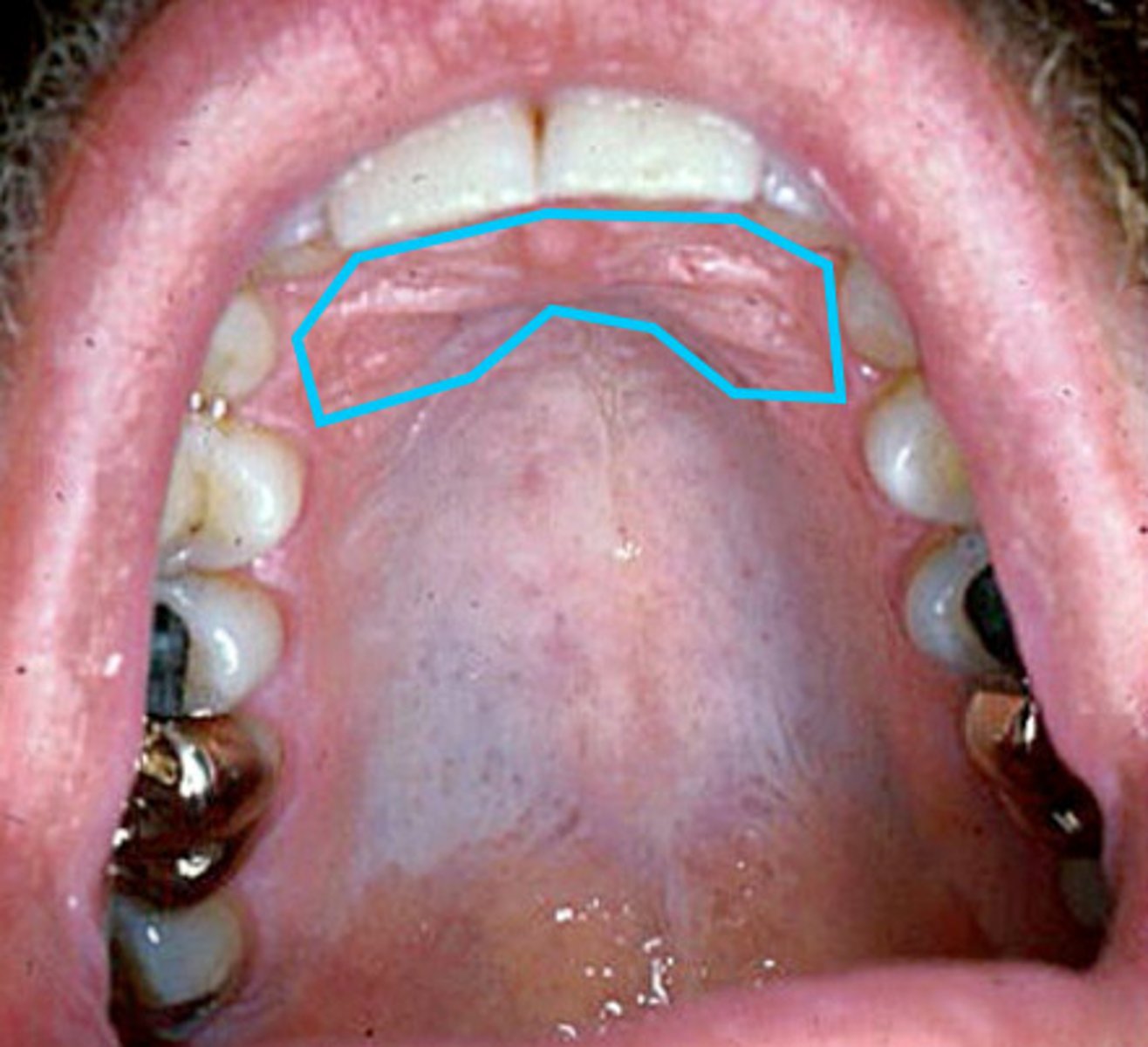 <p>A series of transverse ridges on the anterior part of the palatal mucosa</p>