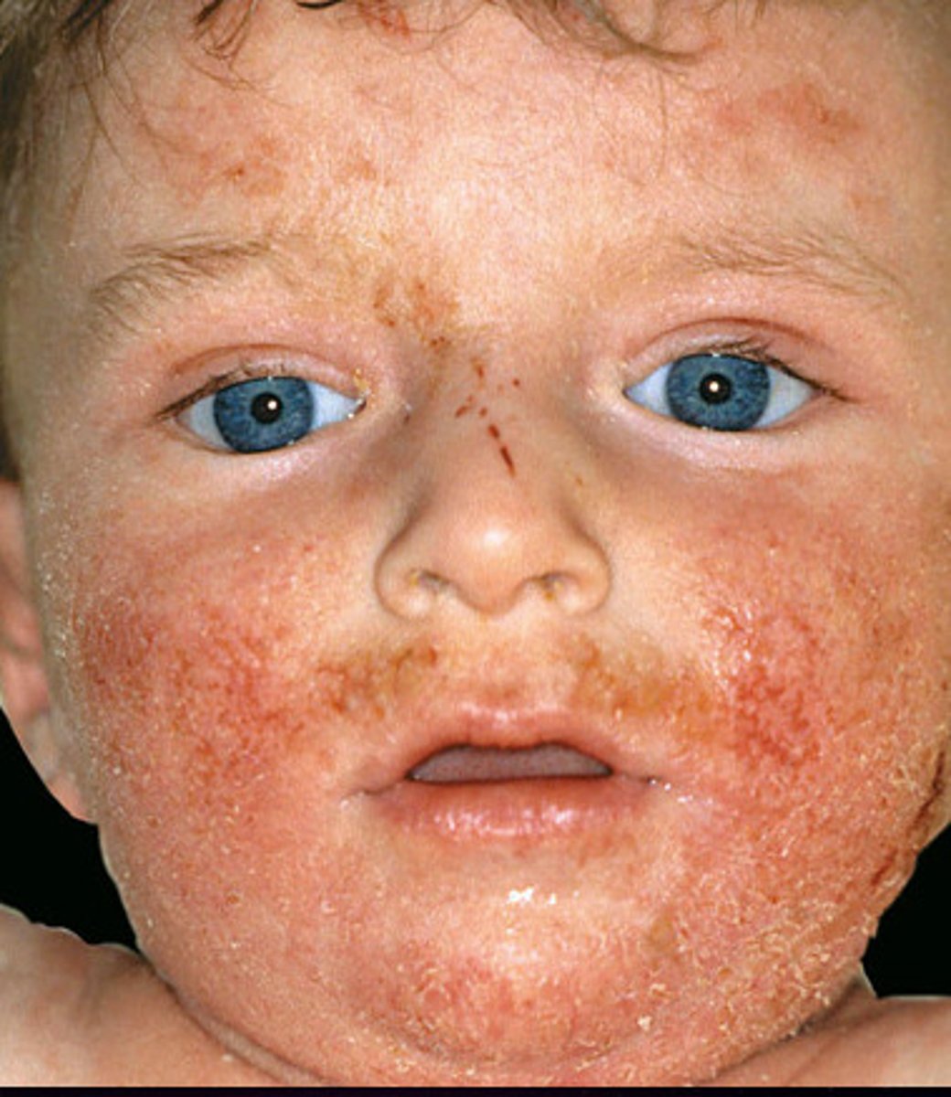 <p>Severe Atopic Dermatitis</p>