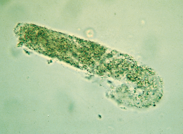 <p>Casts that are coarsely and finely granular</p><ul><li><p>Granules originate from RTE cell <span style="color: red;">lysosomes</span></p></li></ul><p></p>