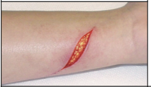 <p>Linear penetrating wound; may have clean-cut edges or torn, ragged edges.</p>