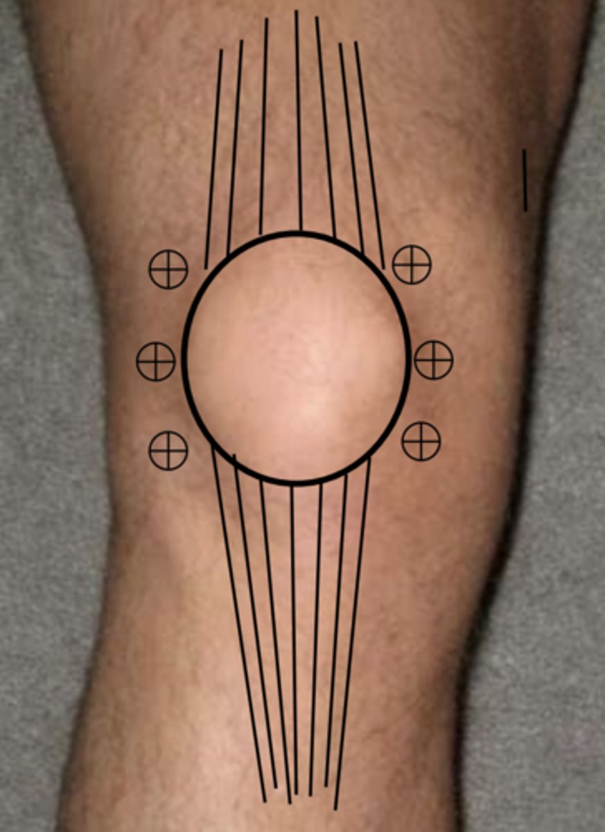 <p>General procedure for knee aspiration</p>