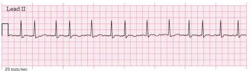 <p>id this EKG</p>