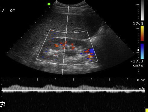 <p>Your patient is 63 y/o with hx of HTN, DM, smoking, carotid artery disease and RLE bypass graft. He presents with uncontrolled hypertension. </p><p>1. Considering patient history and clinical presentation, is suspected disease related to atherosclerosis or FMD?</p><p>2. You started your exam with measurement of RT kidney and assessment of interlobular arteries. You take this image. Is this waveform normal? Which term best describes it? </p><p>3. Considering patient history and reason for exam, where might you stenosis? </p><p>4. Your patient has extensive bowel gas obstructing main renal  artery. Is this waveform with measurements you have obtained diagnostic? </p><p>5. If we use the waveform and measurements obtained in the arcuate arteries to diagnose RAS without evaluating main renal artery, which type of assessment is this considered? Direct or indirect? </p>