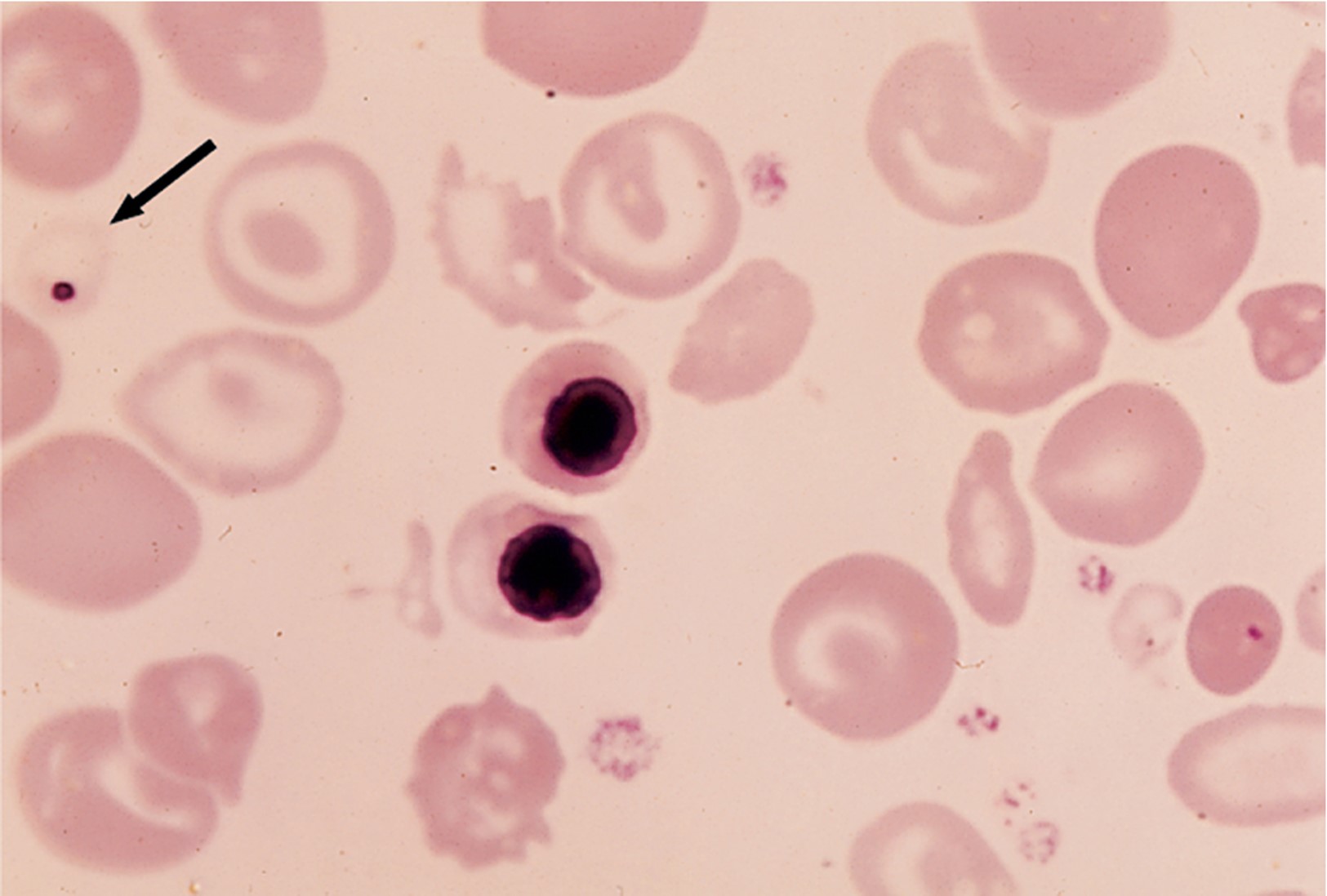 <p>What condition could this smear be showing?</p>