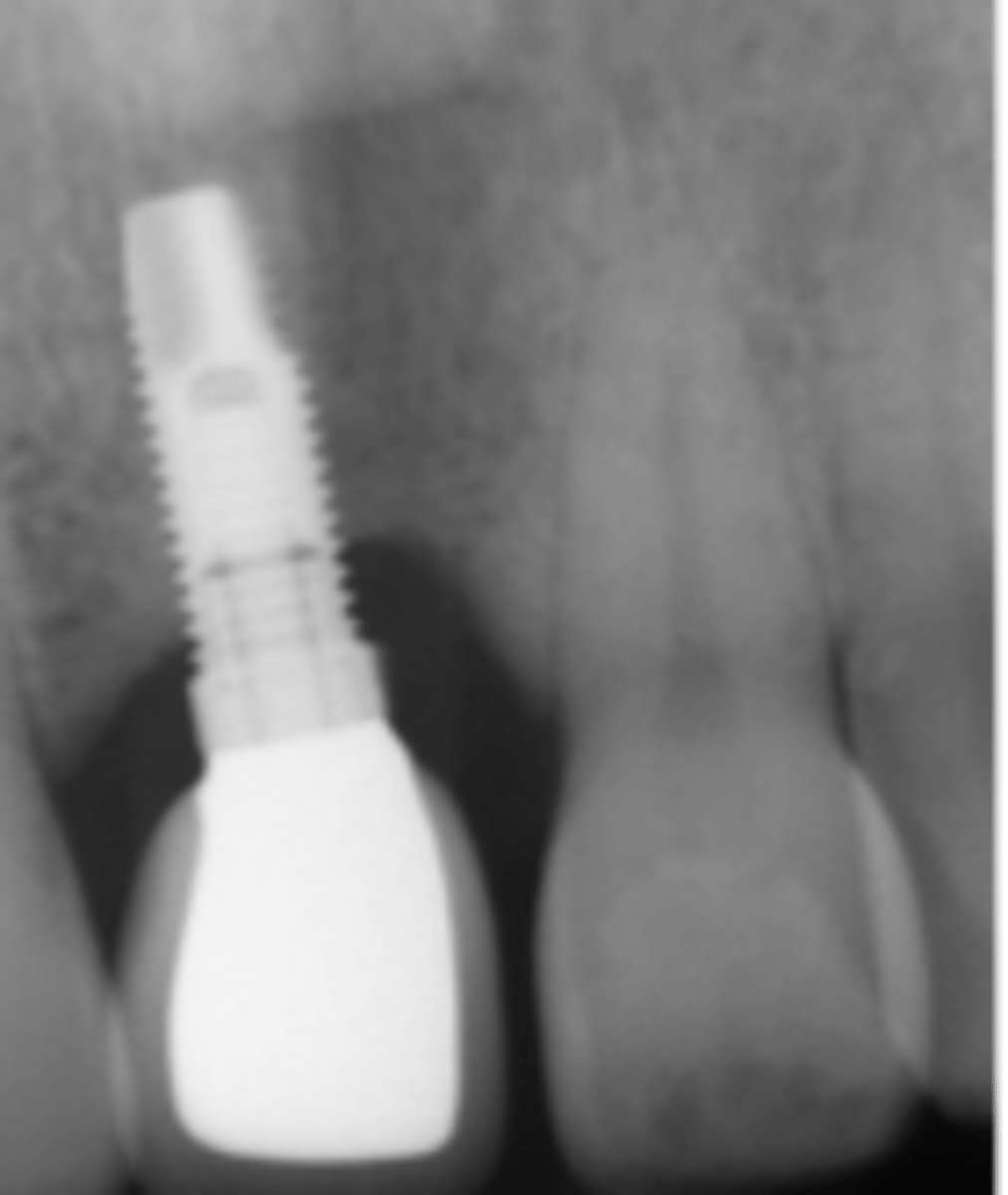 <p>your implant patient presents with presence of peri-implant soft tissue signs of erythema, edema, BoP, suppuration. Upon probing 4mm pockets present. A radiograph exhibits bone loss around the implant. What is the diagnosis?</p>