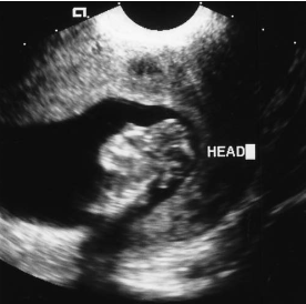 <p><span><span>A patient arrives for an early second-trimester sonogram for gestational dating. An endovaginal image demonstrates a fetal abnormality that is </span><em><span>most </span></em><span>suspicious for:</span></span></p>