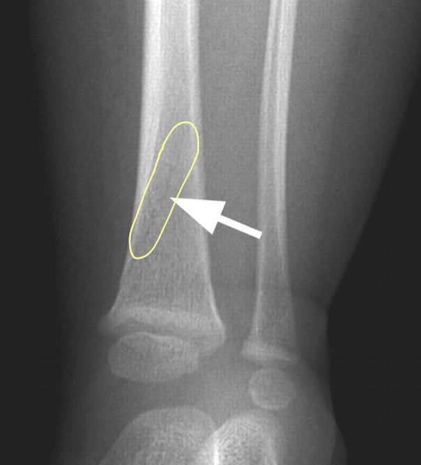 <p>What kind of condition is <em><u>Occult Fractures</u></em>? causes what?</p><ul><li><p>what happens on the tibia?</p></li><li><p>what is it aka?</p></li></ul>