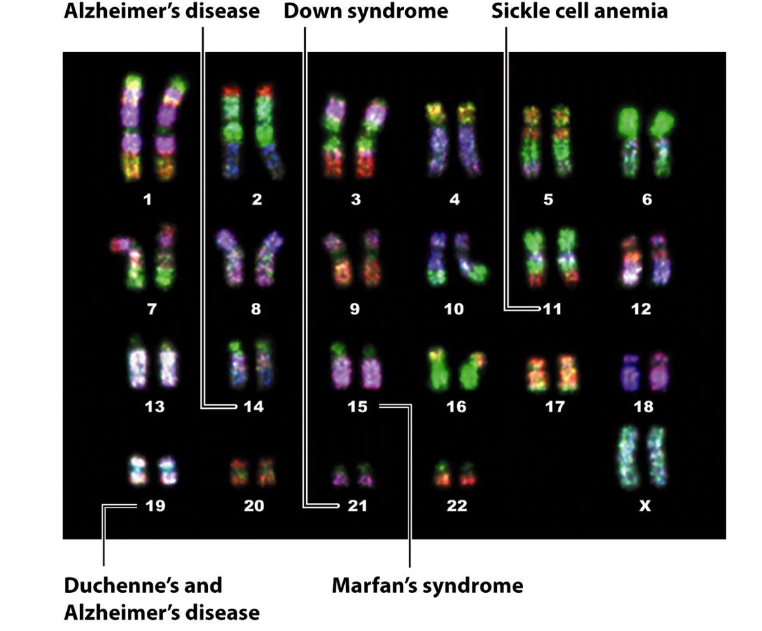 <p>Down syndrome.</p>