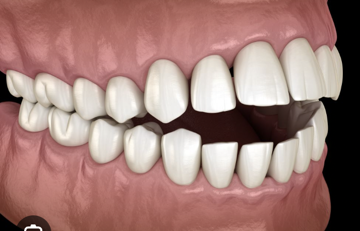 <p>upper and lower jaw align, but teeth do not touch when closed, “open bite” </p>
