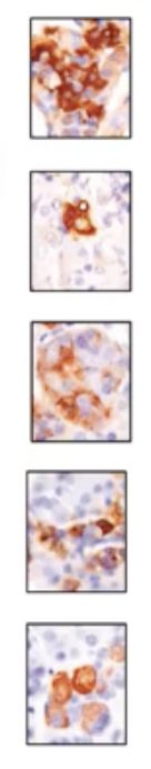 <p>1.Somatotrophs: Secrete human growth hormone</p><p></p><p>2.Thyrotrphs: Secrete thyroid stimulating hormone </p><p></p><p>3.Gonadotrophs: Secrete gonadotropins-Leutinizing hormone and follicle stimulating hormone </p><p></p><p>4.Lactotrophs: Secrete prolactin</p><p></p><p>5.Corticotrophs: Secrete adrenocorticotropic hormone </p>