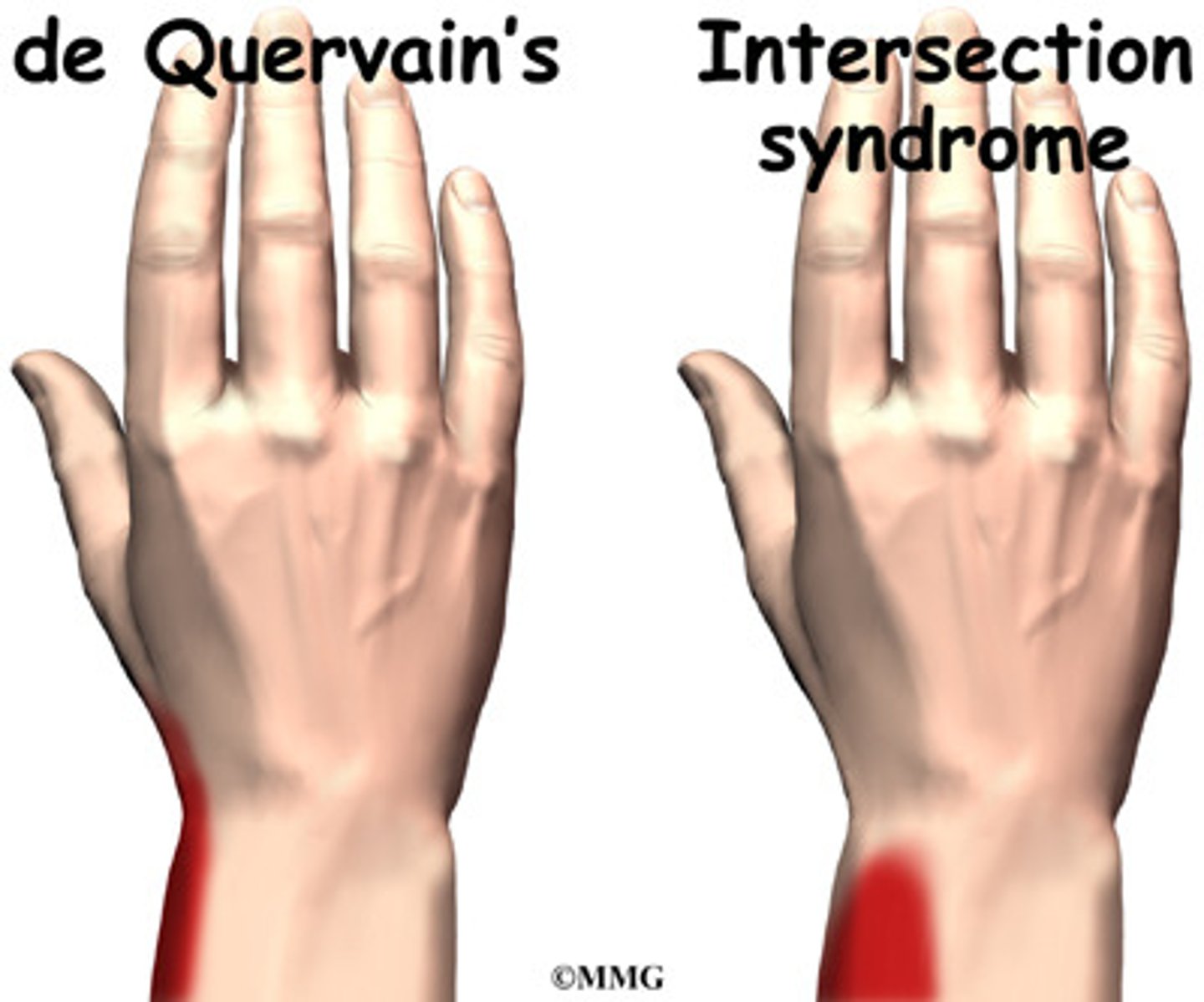 <p>BOTH result from inflammation of the tendons of the wrist BUT:</p><p>Intersection → pain is at the intersection point in the forearm</p><p>deQuervain's tenosynovitis → pain is along the edge of the wrist, closer to the hand</p>