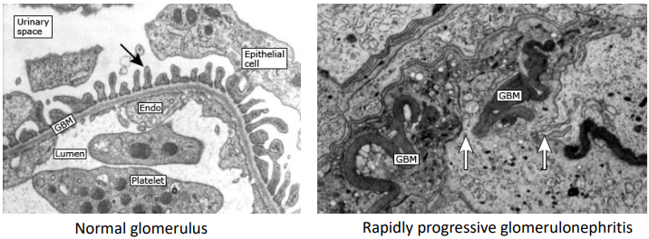 <p>Compare these electron microscopy images:</p><ul><li><p>Breaks in the GBM</p></li><li><p>Fibrin leaks into glomerular capsule → crescent formation</p></li></ul><p></p>