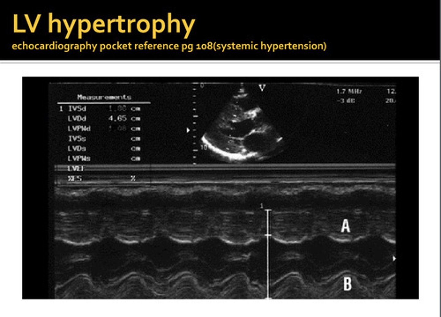 <p>thickening of the septal and/or posterior wall, can be symmetrical or asymmetrical</p>